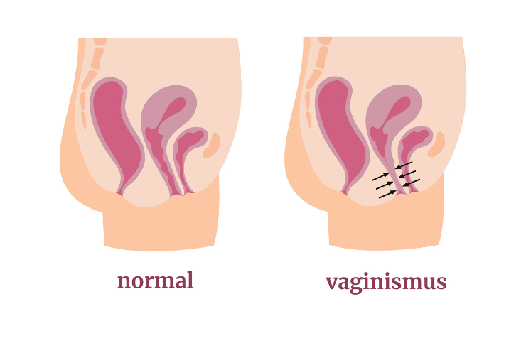 Vaginismus treatment